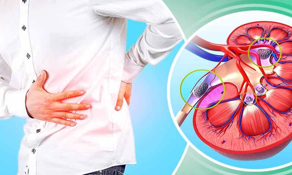  Effective Home Remedies To Get Rid Of Kidney Stones! Kidney Stones, Causes Of Kidney Stones, Health, Health Tips, Good Health, Kidneys, Home Remedies-TeluguStop.com