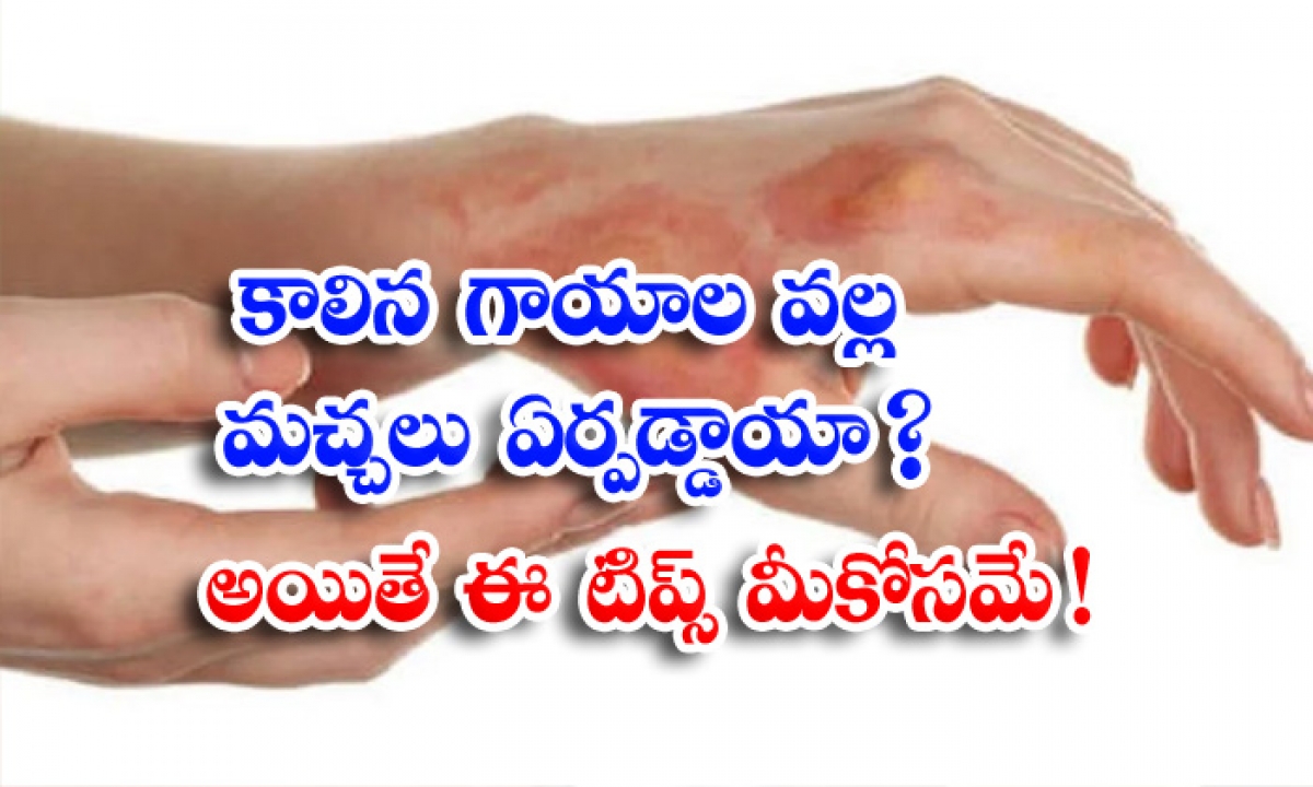  Burn Marks On Skin, Burn Marks, Skin Care, Home Remedies, Latest News, Burning-TeluguStop.com