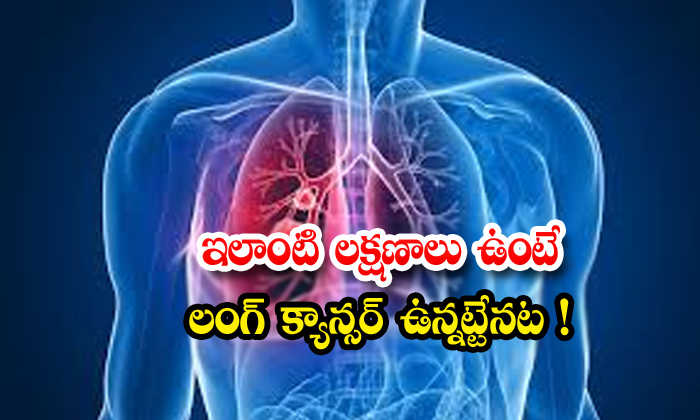  Stages Of Lung Cancer, Treatment, Covid-19-TeluguStop.com