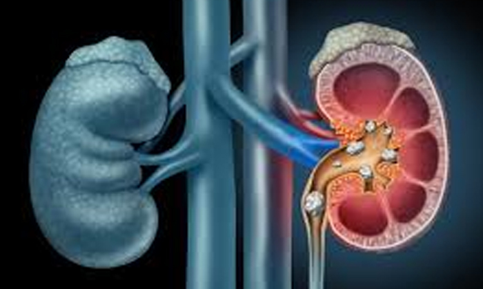 Telugu 400 Grams Of Stone, Body, Doctors, In The Bladder, Lady-Latest News - Telugu Telugu 400 Grams Of Stone, Body, Doctors, In The Bladder, Lady-Latest News - Telugu