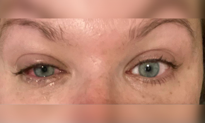 Telugu Bad Effect, England, Eye Drops, Eyes, Gorilla Glue, Kate, Mistake, Poured Glur In Eyes, Surgery, Uk Woman, United Kingdom (uk)-Latest News - Telugu Telugu Bad Effect, England, Eye Drops, Eyes, Gorilla Glue, Kate, Mistake, Poured Glur In Eyes, Surgery, Uk Woman, United Kingdom (uk)-Latest News - Telugu