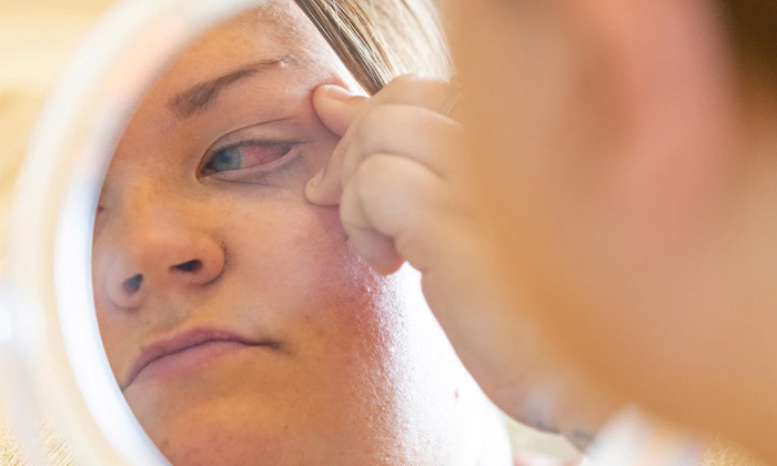 Telugu Bad Effect, England, Eye Drops, Eyes, Gorilla Glue, Kate, Mistake, Poured Glur In Eyes, Surgery, Uk Woman, United Kingdom (uk)-Latest News - Telugu Telugu Bad Effect, England, Eye Drops, Eyes, Gorilla Glue, Kate, Mistake, Poured Glur In Eyes, Surgery, Uk Woman, United Kingdom (uk)-Latest News - Telugu