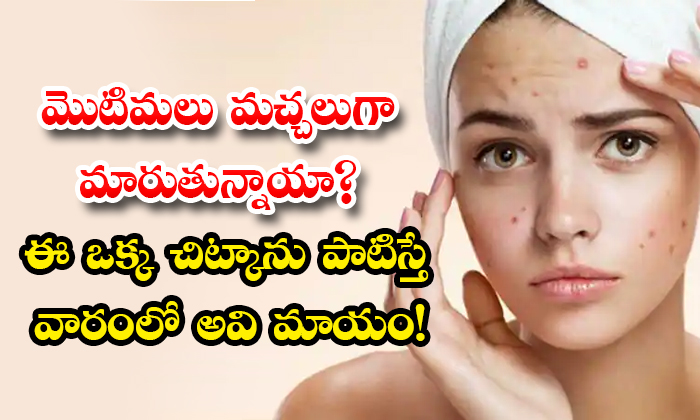  Best Home Remedy To Get Rid Of Pimple Marks Naturally Details! Home Remedy, Pimple Marks, Pimples, Latest News, Skin Care, Skin Care Tips, Beauty, Beauty Tips,-TeluguStop.com