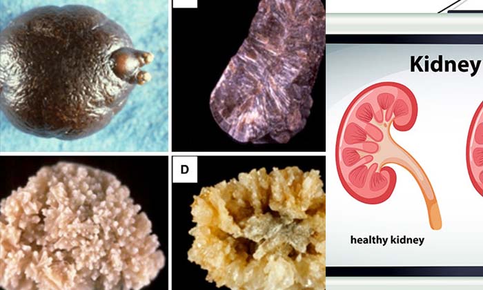  How Many Types Of Kidney Stones Are Formed In Human Body , Human Body , Kidney-TeluguStop.com