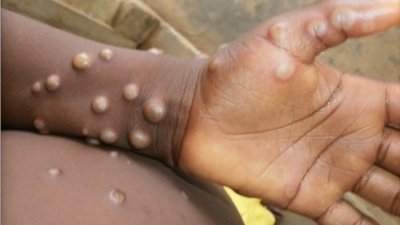  Is Waning Smallpox Vax Protection Behind Monkeypox Outbreak?-TeluguStop.com