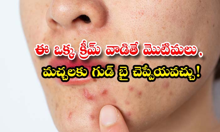  Best Natural Cream For Pimples And Pimple Marks , Natural Cream, Pimples, Pimpl-TeluguStop.com