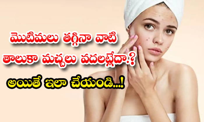  Effective Home Remedy For Acne Marks!, Home Remedy, Acne Marks, Skin Care, Skin Care Tips, Beauty, Beauty Tips, Latest News, Acne, Pimple Marks, Pimples-TeluguStop.com