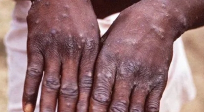  Monkeypox Mutated Rapidly Than Thought: Study-TeluguStop.com