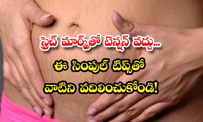  How To Get Rid Of Stretch Marks At Home, Stretch Marks, Stretch Marks Removal Tips, Stretch Marks Treatment, Women, Latest News, Skin Care, Skin Care Tips, Beauty, Beauty Tips-TeluguStop.com